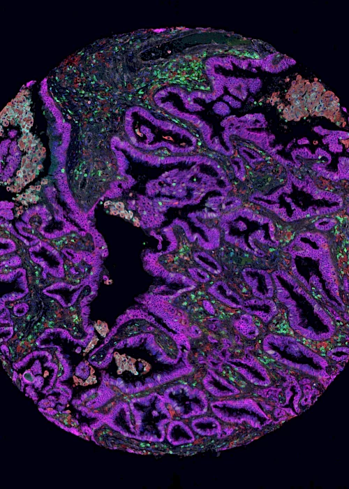Cancer pathology revealed with the aid of statistics