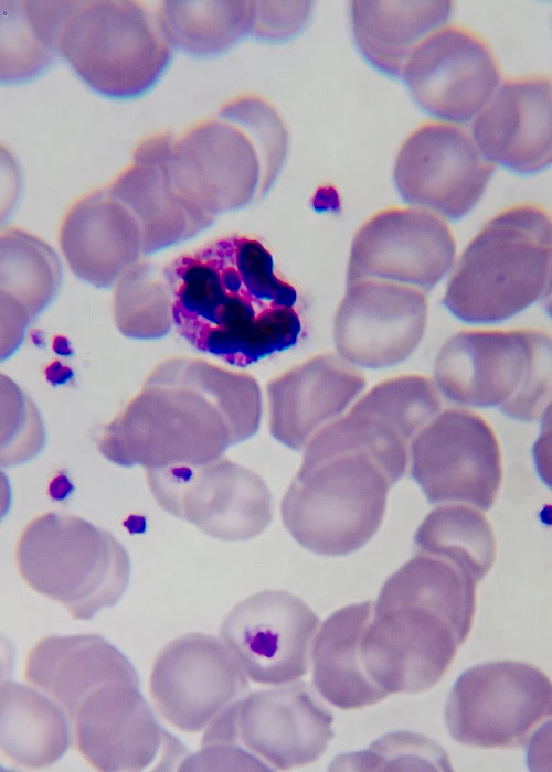 Identifying pharmacogenomic vulnerabilities in malaria treatment